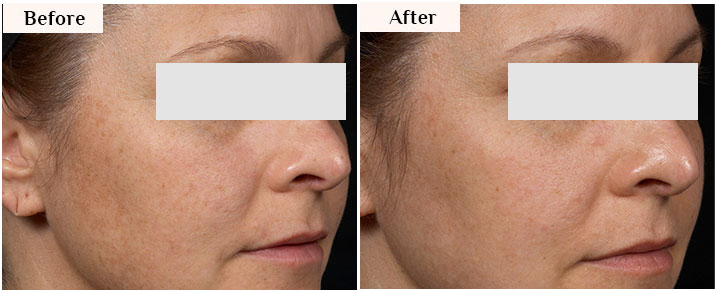 clear+brilliant laser before after